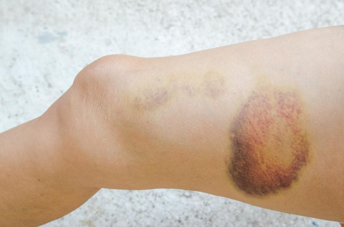 Skin hematoma diagnosis Yellow-purple hematoma on a leg near the knee, showing a healing bruise on the skin.
