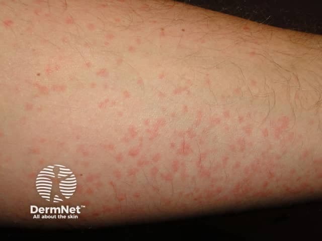 Cold urticaria on the arms Scattered red spots and welts on the forearm, typical of cold-induced urticaria (hives).
