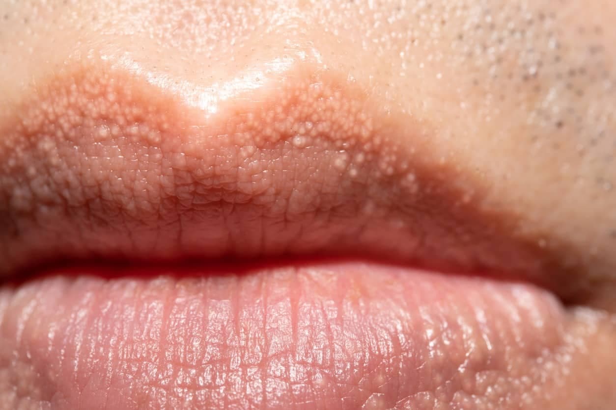 Fordyce spots on the lips Small whitish-yellow papules along the lip border, characteristic of Fordyce spots.
