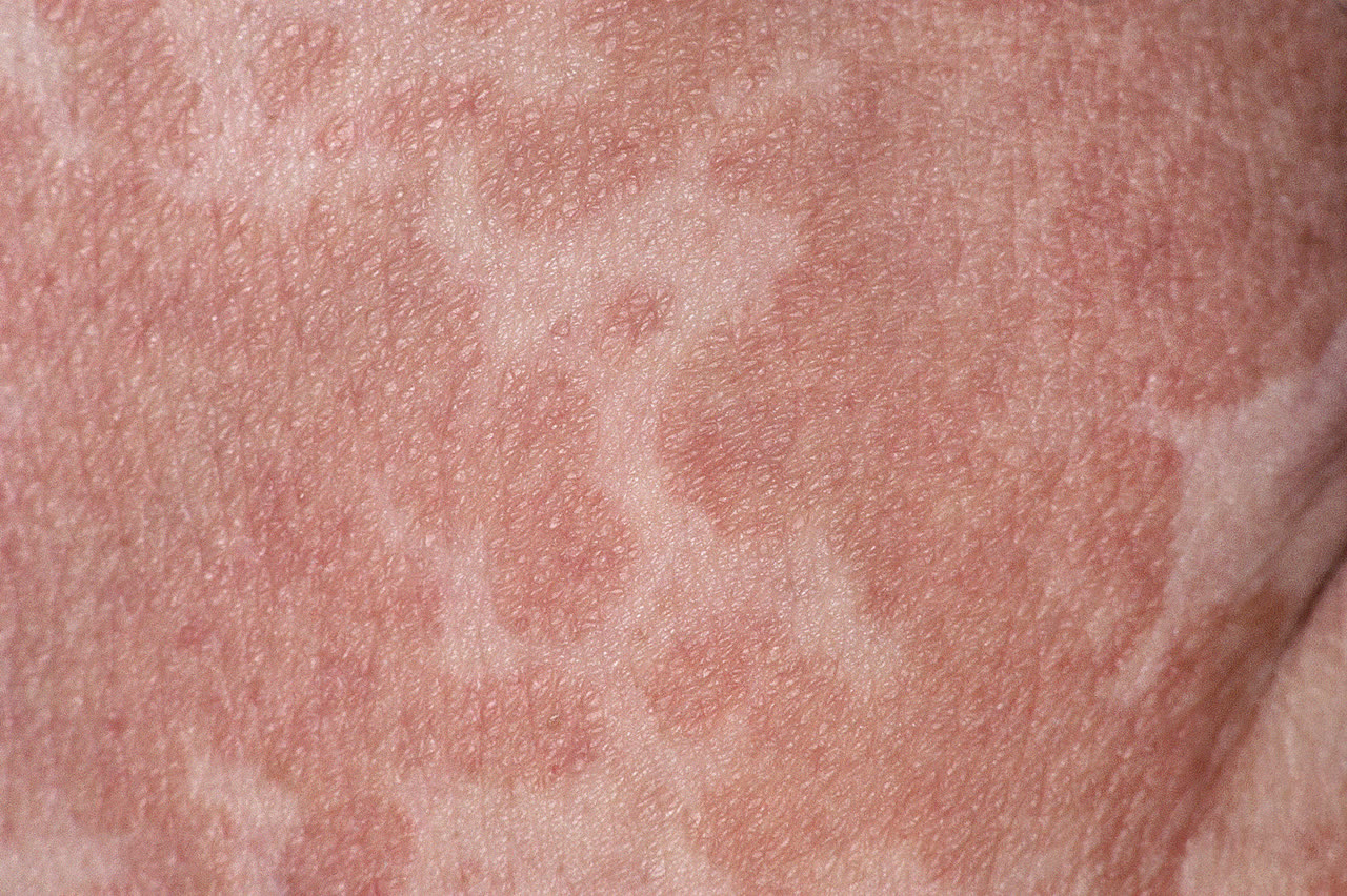 Tinea versicolor: lighter and darker patches with fine scaling on the back and shoulders